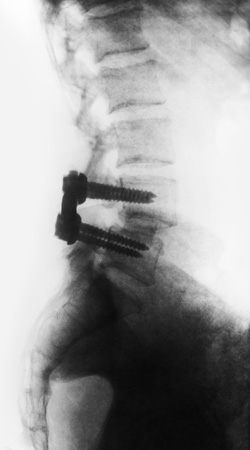 spondylolisthesis